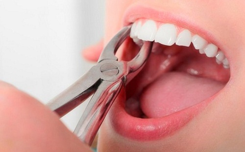 Nguy hiểm khi nhổ răng tại nhà